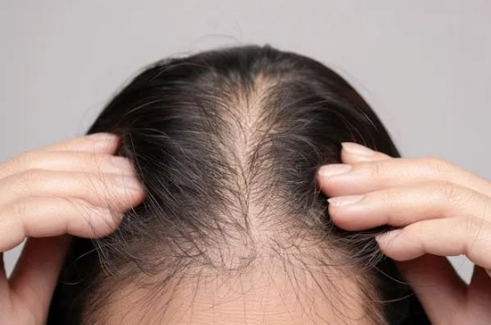 علاج تساقط الشعر